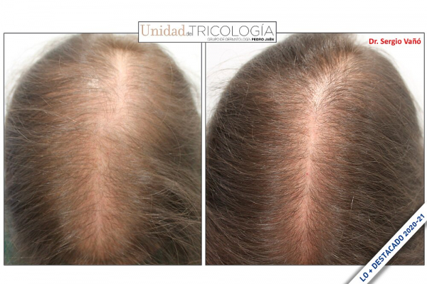 En verano: El minoxidil oral supone una terapia segura para el tratamiento de la alopecia androgénica
