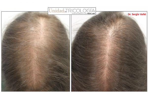 El minoxidil oral supone una terapia segura para el tratamiento de la alopecia androgénica